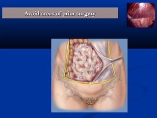 Avoid areas of prior surgery

 