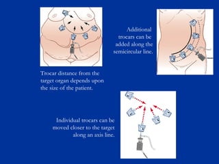Additional
trocars can be
added along the
semicircular line.
Trocar distance from the
target organ depends upon
the size of the patient.

Individual trocars can be
moved closer to the target
along an axis line.

 