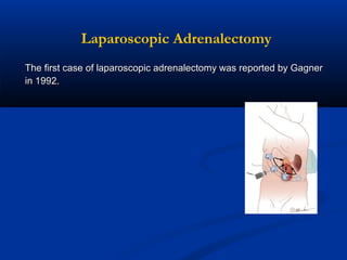 Laparoscopic Adrenalectomy
The first case of laparoscopic adrenalectomy was reported by Gagner
in 1992.

 