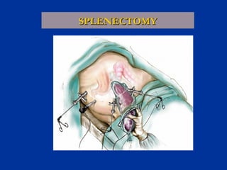 SPLENECTOMY

 