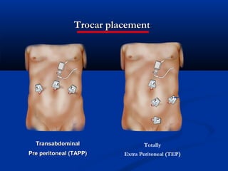 Trocar placement:

Additional
trocar

Transabdominal

Totally

Pre peritoneal (TAPP)

Extra Peritoneal (TEP)

 