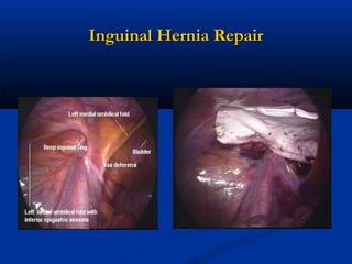 Inguinal Hernia Repair

 