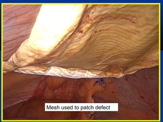 Mesh used to patch defect

 