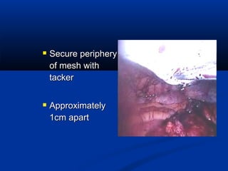  Secure periphery
of mesh with
tacker

 Approximately
1cm apart

 