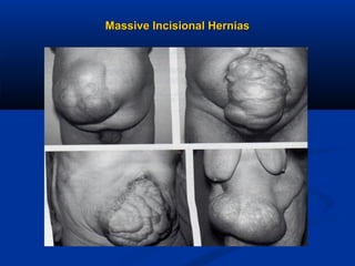 Massive Incisional Hernias

 