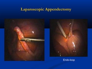Laparoscopic Appendectomy

Endo-loop

 