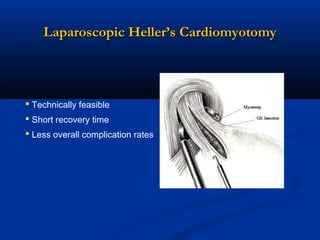 Laparoscopic Heller’s Cardiomyotomy

 Technically feasible
 Short recovery time
 Less overall complication rates

 