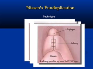 Nissen’s Fundoplication
Technique

 
