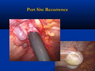 Port Site Recurrence

 