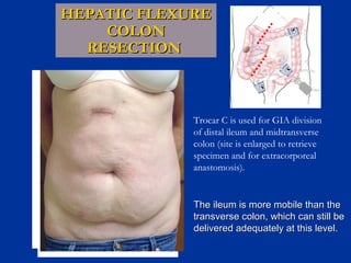 HEPATIC FLEXURE
COLON
RESECTION

C

Tension-free anastomosis

B
A

Trocar C is used for GIA division
of distal ileum and midtransverse
colon (site is enlarged to retrieve
specimen and for extracorporeal
anastomosis).

The ileum is more mobile than the
transverse colon, which can still be
delivered adequately at this level.

 
