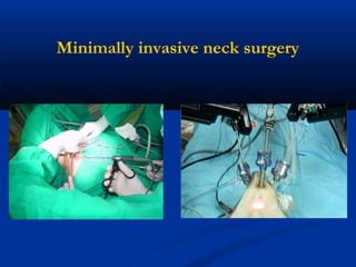 Minimally invasive neck surgery

 