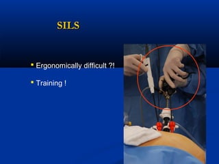SILS

 Ergonomically difficult ?!
 Training !

 