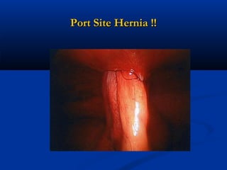 Port Site Hernia !!

 