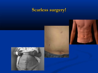 Scarless surgery!

 