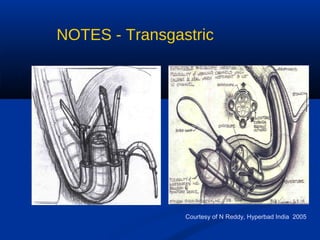 NOTES - Transgastric

Courtesy of N Reddy, Hyperbad India 2005

 