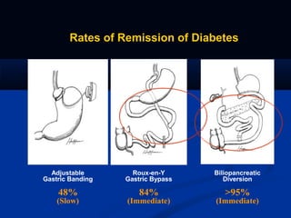 Rates of Remission of Diabetes

Adjustable
Gastric Banding

Roux-en-Y
Gastric Bypass

Biliopancreatic
Diversion

48%

84%

>95%

(Slow)

(Immediate)

(Immediate)

 