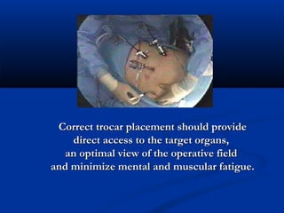 Correct trocar placement should provide
direct access to the target organs,
an optimal view of the operative field
and minimize mental and muscular fatigue.

 