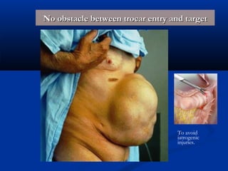 No obstacle between trocar entry and target

To avoid
iatrogenic
injuries.

 