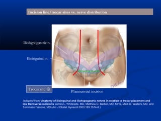 Incision line/trocar sites vs. nerve distribution
Epigastric a.

Iliohypogastric n.

Ilioinguinal n.

Trocar site

Pfannenstiel incision

(adapted from) Anatomy of ilioinguinal and iliohypogastric nerves in relation to trocar placement and
low transverse incisions James L. Whiteside, MD, Matthew D. Barber, MD, MHS, Mark D. Walters, MD, and
Tommaso Falcone, MD (Am J Obstet Gynecol 2003;189:1574-8.)

 