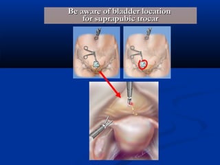 Be aware of bladder location
for suprapubic trocar

 