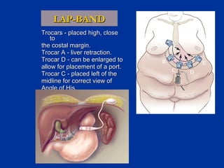LAP-BAND
Trocars - placed high, close
to
the costal margin.
Trocar A - liver retraction.
Trocar D - can be enlarged to
allow for placement of a port.
Trocar C - placed left of the
midline for correct view of
Angle of His.

A
B

E
C

D

 