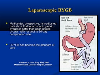 Laparoscopic RYGB
 Multicenter, prospective, risk-adjusted
data show that laparoscopic gastric
bypass is safer than open gastric
bypass, with respect to 30-day
complication rate.

 LRYGB has become the standard of
care

Hutter et al. Ann Surg. May 2006
Massachusetts General Hospital, Boston.

 