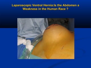 Laparoscopic Ventral Hernia:Is the Abdomen a
Weakness in the Human Race ?

 