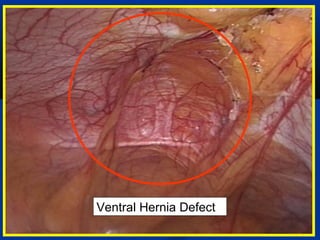 Ventral Hernia Defect

 