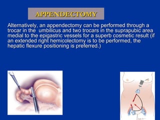 APPENDECTOMY
Alternatively, an appendectomy can be performed through a
trocar in the umbilicus and two trocars in the suprapubic area
medial to the epigastric vessels for a superb cosmetic result (if
an extended right hemicolectomy is to be performed, the
hepatic flexure positioning is preferred.)

 
