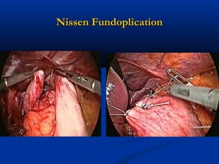 Nissen Fundoplication

 