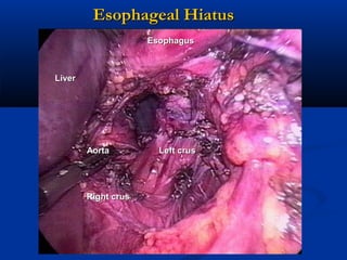 Esophageal Hiatus
Esophagus

Liver

Aorta

Right crus

Left crus

 