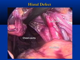 Hiatal Defect

Left crus

Chest cavity

Stomach

 