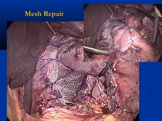 Mesh Repair

 