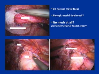 • Do not use metal tacks
• Biologic mesh? dual mesh?
Esophagus

• No mesh at all?

(remember original Toupet repair)
Polypropylene mesh

Mesh
Circular mesh

Wrap

Fundoplication

 