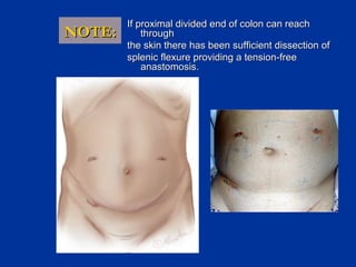 NOTE:

If proximal divided end of colon can reach
through
the skin there has been sufficient dissection of
splenic flexure providing a tension-free
anastomosis.

 