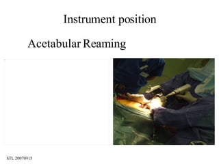 SøRen Toksvig Larsen. The Role Of Cas (Computer Assisted Surgery ...