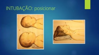INTUBAÇÃO: posicionar
 