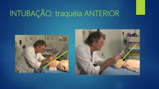 INTUBAÇÃO: traquéia ANTERIOR
 