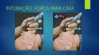 INTUBAÇÃO: FORÇA PARA CIMA
 