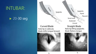 INTUBAR:
 20-30 seg
 