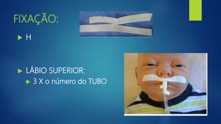 FIXAÇÃO:
 H
 LÁBIO SUPERIOR:
 3 X o número do TUBO
 