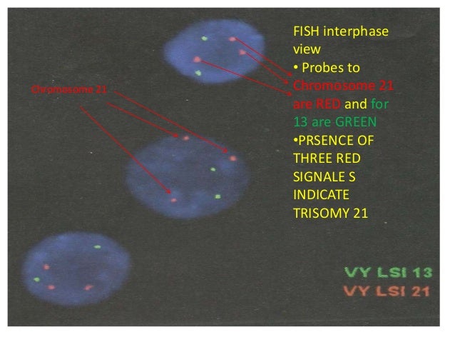 FISH interphase  view  â¢ Probes to  Chromosome 21  are RED and for  13 are GREEN  â¢PRSENCE OF  THREE RED  SIGNALE S  INDIC...