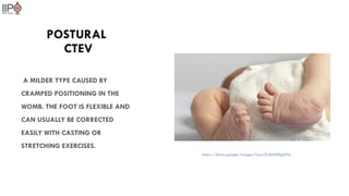 Ctev Types Comprehensive Overview of Congenital Talipes Equinovarus (CTEV) | PPTX
