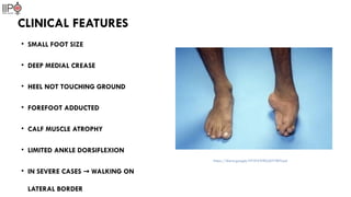 Comprehensive Overview of Congenital Talipes Equinovarus (CTEV) | PPTX