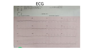 ECG
 