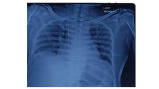 Chest X-ray
 