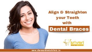 Align & Straighten
your Teeth
with 
Dental Braces
www.chennaidentalclinic.in
 