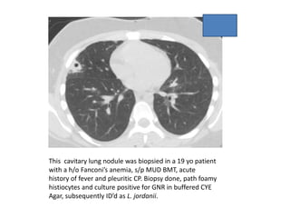 This cavitary lung nodule was biopsied in a 19 yo patient
with a h/o Fanconi’s anemia, s/p MUD BMT, acute
history of fever and pleuritic CP. Biopsy done, path foamy
histiocytes and culture positive for GNR in buffered CYE
Agar, subsequently ID’d as L. jordanii.
 
