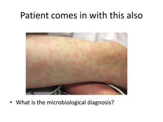 Patient comes in with this also
• What is the microbiological diagnosis?
 
