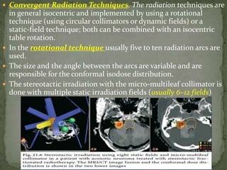 Stereotactic Radiosurgery/ Radiotherapy | PPTX